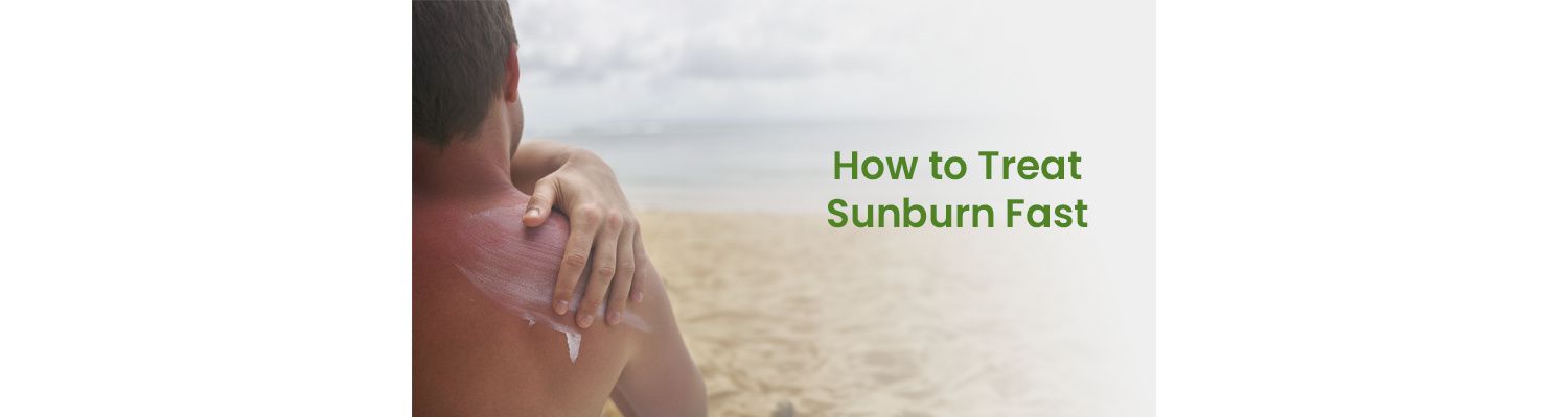 How to Treat Sunburn Fast
