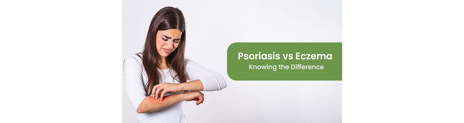 Psoriasis vs Eczema: Knowing the Difference