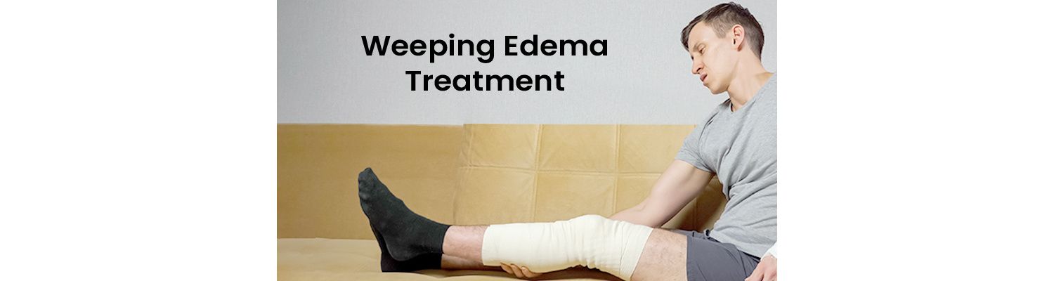 Weeping Edema How Do You Treat Leaky Legs