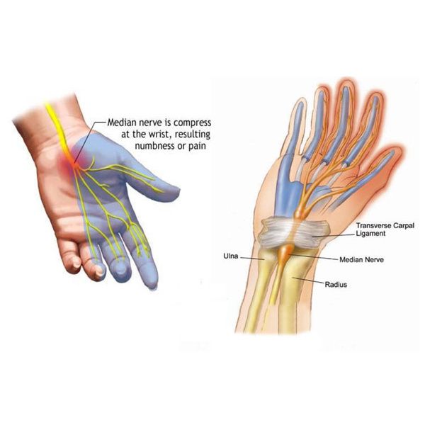 Ossur Exoform Wrist Splint - Tendonitis and Carpal Tunnel Brace - Simply  Medical