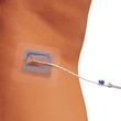 Merit Medical StayFIX Catheter Fixation Device