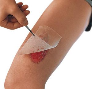 Smith & Nephew Cuticerin Impregnated Dressing