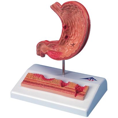 Buy A3BS Stomach with Ulcers Model